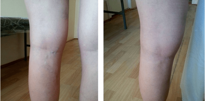 Varices nas pernas